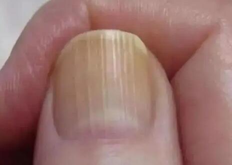 指甲有竖纹是身体的什么信号（指甲有竖纹是身体的什么信号中医）