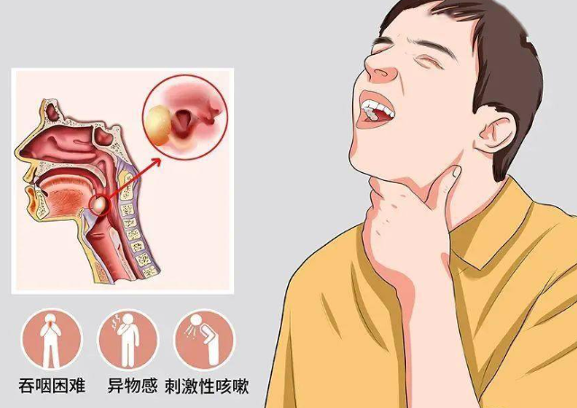 喉咙有异物感吞咽有堵塞感，引发原因有这5点，你都了解过吗？