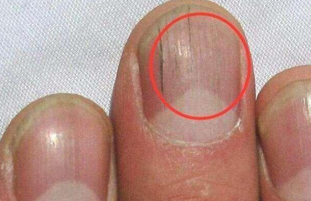 指甲有竖纹是身体的什么信号（指甲有竖纹真的肝不好吗）
