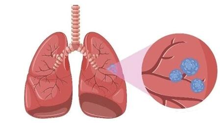 肺部有结节是怎么回事严重吗（女性肺部有结节是怎么回事严重吗）