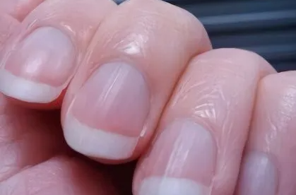 指甲有竖纹是身体的什么信号（指甲有竖纹是身体的什么信号图片）